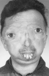 Facial-appearance-prominent-eyes-small-mouth-bulbous-cheeks-beaked-nose-and-small.png